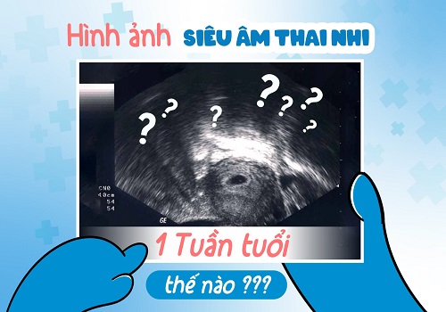 Phá thai 1 tuần có thực hiện được không? Lưu ý những gì