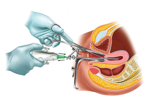 Hút thai có an toàn không? Địa chỉ hút thai uy tín tại Đắk Lắk