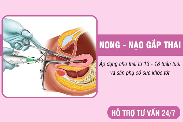Phá thai 14 tuần - Thông tin đầy đủ cho thai phụ