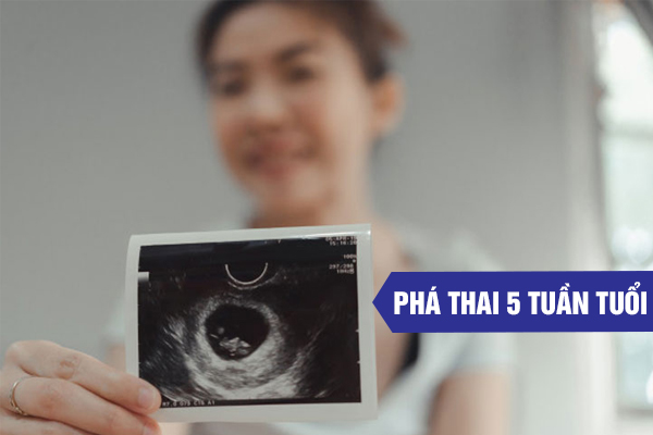 Tổng hợp phương pháp phá thai 6 tuần và địa chỉ uy tín